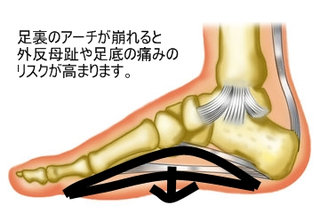 外反母趾の痛みは足底のアーチの崩れから。